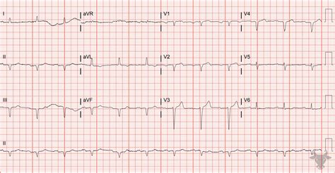 poor r wave progression in hindi